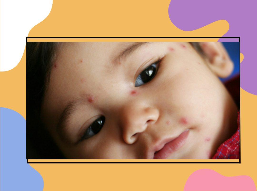 5 Common Baby Skin Problems And How To Deal With Them