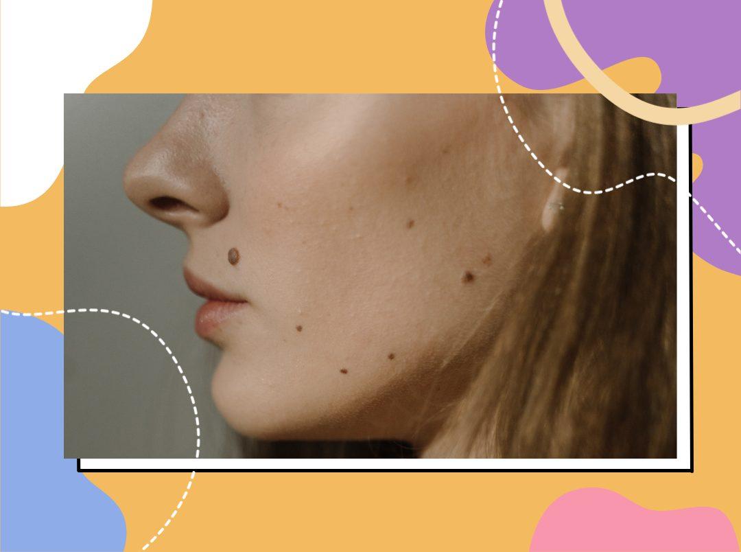 Moles No More: 10 Best Mole Removal Creams That&#8217;ll Get The Job Done!